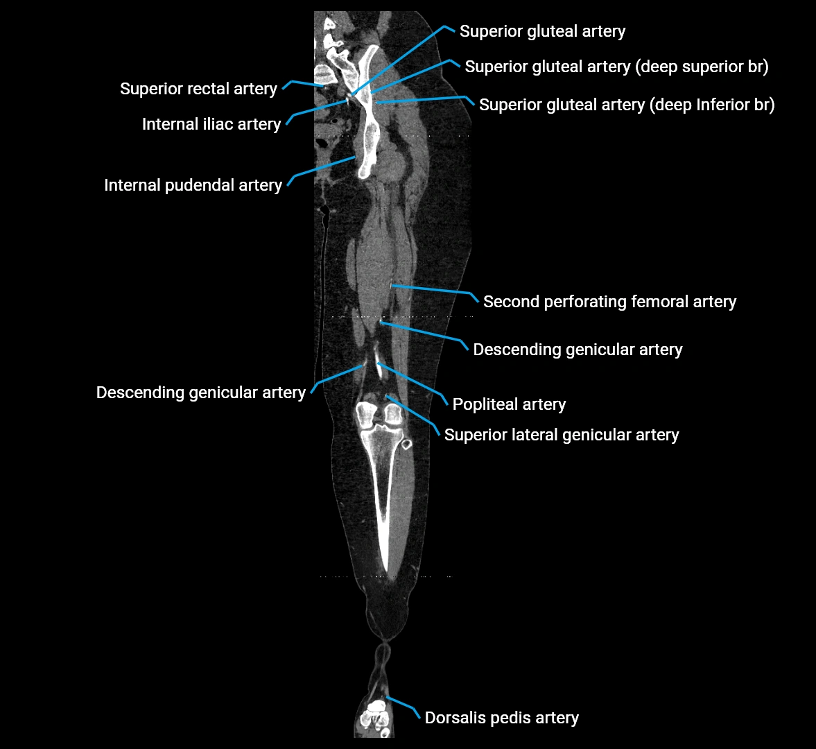 CTA lower limb coronal cross sectional anatomy labelled image _51 (2).webp